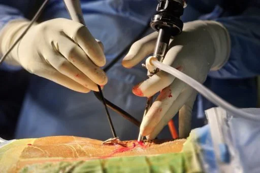 Endoscopic Spine Surgery in Kerala